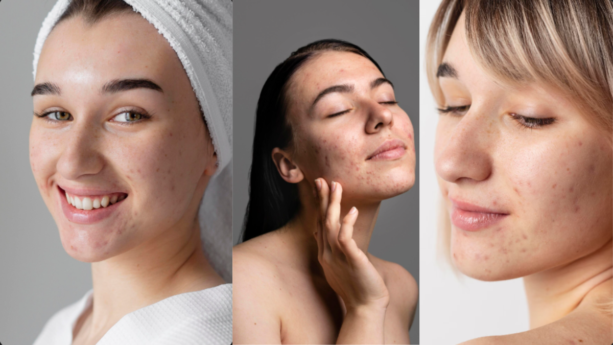 How to Build a Skincare Routine That Actually Works For Your Acne?